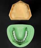 The acrylic mix must be flush on the surface of the model so that the dental arch obtains the shape of the mucous membrane. 2.3.