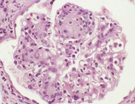 12. Diabetic Nephropathy 133 Figure 12.1. Glomerulus from patient with diabetic glomerulosclerosis showing segmental mesangial matrix expansion and hypercellularity that is most pronounced on the left.