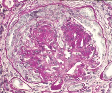 136 J.C. Jennette Figure 12.6. Glomerulus from patient with diabetic glomerulosclerosis showing cellular crescent formation (PAS stain). No other glomerular disease was identified.