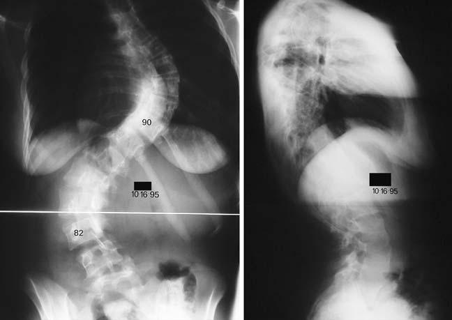 Eur Spine J (2007) 16:1379 1385 1381 translation (AVT) was defined as the distance from the middle of the lumbar apical vertebral body to the CSVL [12].