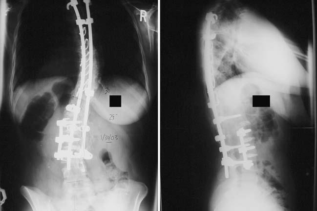 Eur Spine J (2007) 16:1379 1385 1383 Fig. 3 Postoperative radiographs at 8 years followup Table 2 Coronal balance, mean values * Group 1 Group 2 P-value C7 plumb line (cm), preop 0.43 ( 1 to 2) 0.