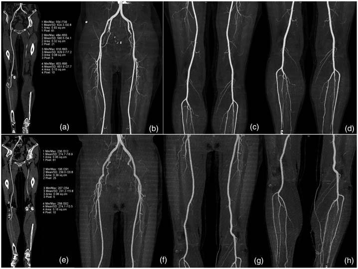 Qi et al. 5 Fig. 1. Lower extremity CTA at 70 kvp in a 60-year-old woman (a d) and at 120 kvp in a 57-year-old woman (e h).