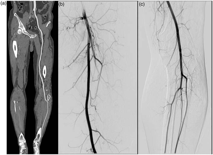 6 Acta Radiologica 0(0) Fig. 2. Lower extremity CTA at 70 kvp and digital subtraction angiography images in our study.