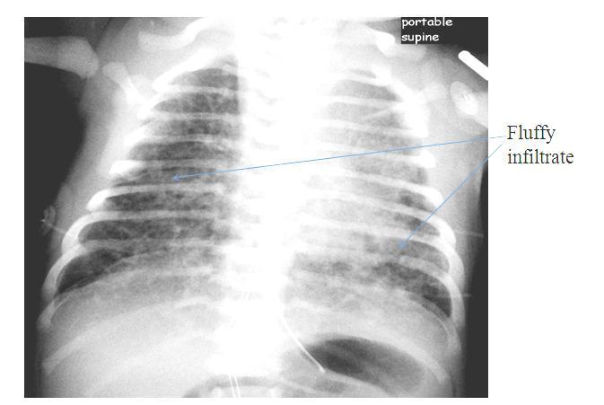 as they might have PPH (Persistent Pulmonary Hypertension), with right to left shunting caused by increased pulmonary vascular resistance.
