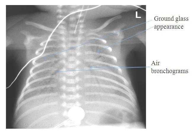 This is a typical/classical RDS X ray; we can see tracheal tube inside the trachea, ground glass appearance ورقة راشش عليها ملح و فلفل),(زي and air bronchogram because there are altelectatic changes
