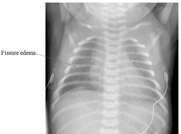 The problem is there is fluids present in the lungs, maternal IV fluids associated. CXR with prominent vascular markings. This X-ray is classical for Transient Tachypnea of the Newborn.