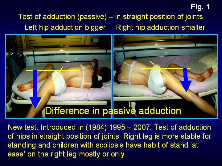 Figures: 12 Figure 1 : Test of adduction of hips in