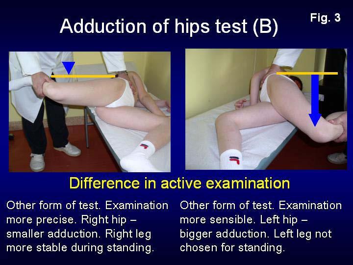 13 Figure 3 : Te st of adduction of hips in straight position of