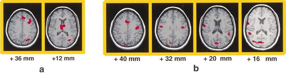 OVERT VERBAL RESPONDING DURING fmri SCANNING 649 FIG. 4 FIG. 6 FIG. 4. Regions exhibiting significantly greater activation during overt as compared to covert responses for the group analysis.