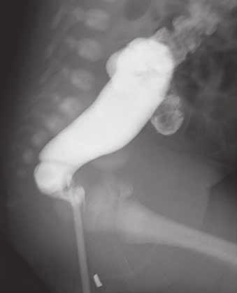 Figure 1 1a 1b 1c Figure 1. a. The diameter of the sigmoid colon is larger than that of the rectum, indicating a reverse rectosigmoid index. b. A transition zone is found at the sigmoid colon (arrow).