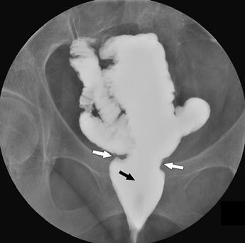 diverting ileostomy show normal appearance of ileal pouch and ileoanal anastomosis (white arrows), which has smooth, symmetric margins and diameter of 20 mm.