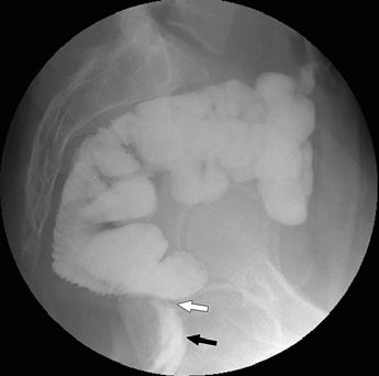 reflux of contrast material into dilated loops of distal ileum. This patient presented with symptoms of obstruction (nausea, vomiting, and abdominal distention) after ileostomy closure.