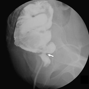 critical anastomotic caliber at or below which such strictures were likely to develop.