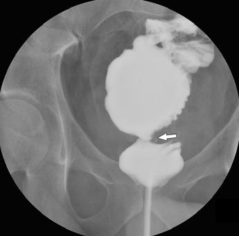 However, patient had no clinical signs of obstruction after ileostomy closure, and no further imaging studies were performed. This was one of three false-positive anastomotic strictures in our study.