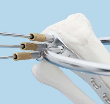 Use the wire guides to help position the plate on the bone. Insert a 2.5 mm guide wire through the 2.5 mm wire guide. Readjust plate position, if necessary.