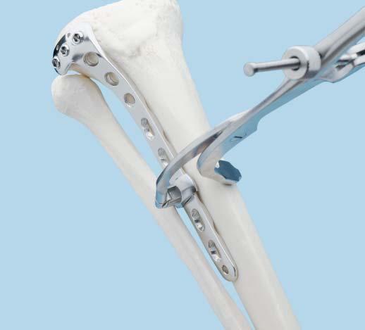 Using atraumatic technique, temporarily secure the plate shaft to the bone with plate holding forceps. Confirm rotation of the extremity by clinical examination.