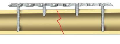 Important: If a combination of cortex (1) and locking screws (2) is used, a cortex screw should be