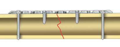 1 2 2 1 Correct Important: If locking screws (1) have been used to fix the plate to a fragment,