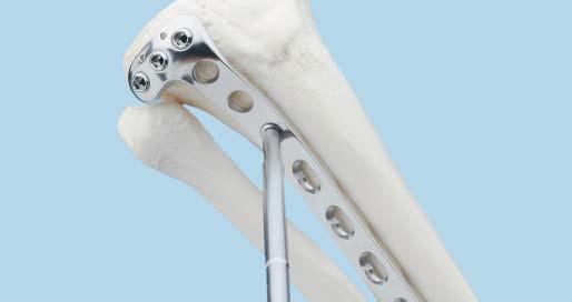 0 mm screws make predrilling and pretapping unnecessary in most cases. If necessary, in dense bone, the lateral cortex can be predrilled with the 4.3 mm cannulated drill bit.