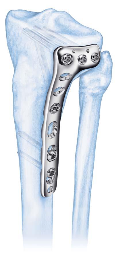 4.5 mm LCP Proximal Tibia Plates The Synthes 4.