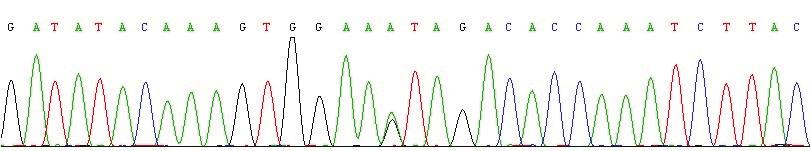 90 Figure 2. The sequence of the TTR gene showed heterozygous mutation on exon 3 at codon 277, from wild-type ATA (Ile) to mutant GTA (Val) (arrow).