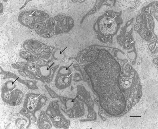A a f h NU b Figure 5: Destruction of unmyelinated fibres at an early stage of transthyretin amyloidosis Electron micrograph of a sural nerve biopsy specimen from a 37-year-old woman carrying the