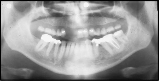 Failure to Remove Tongue Ring Problem: Anything removable in the mouth should be taken out before exposing a panoramic film.