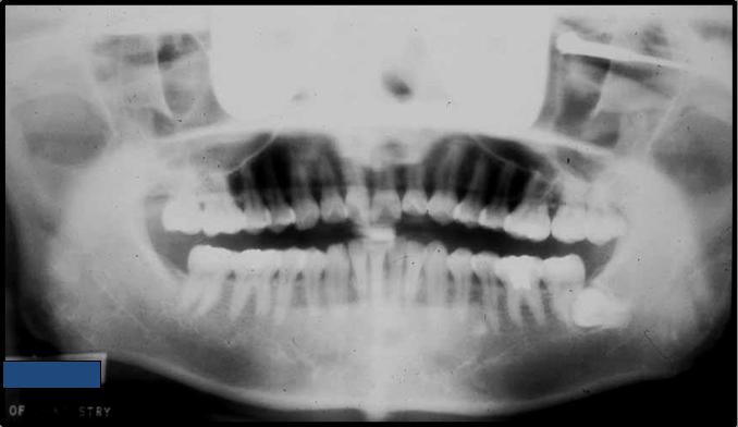 Result: As the x-ray beam passes around the patient, objects such as jewelry or dense bone will produce a real image on the side where the object is