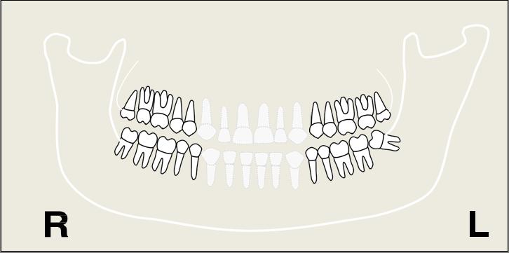 Result: The anterior teeth will appear wider and will be