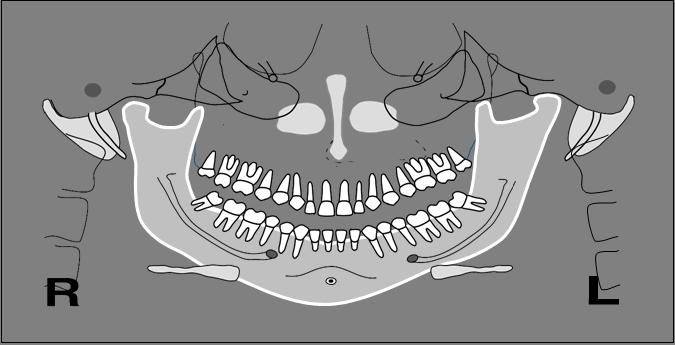 side. Head Tipped Down, continued Notice how short the mandibular