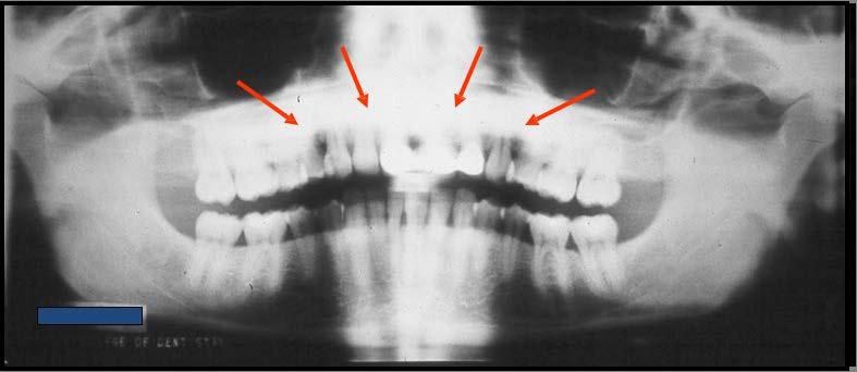 Head Tipped Up, continued Result: In the radiographic image below, the hard palate (red arrows) is covering the roots of the maxillary teeth. Note the reverse smile.