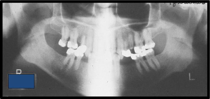 Cervical Vertebrae (Spine), continued This panoramic image shows the radiopaque shadow caused by the cervical vertebrae in a patient that is not standing straight.