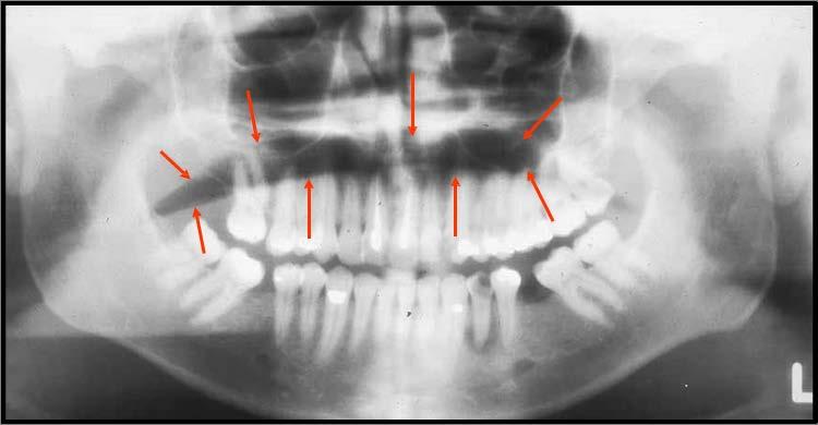 Result: The Palatoglossal Air Space is a dark air space which is superimposed over the apicies of the maxillary teeth on a panoramic image.