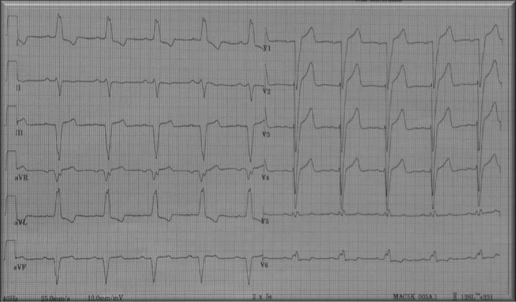 Case report:, 60 yrs Cardiologic history: Dilated