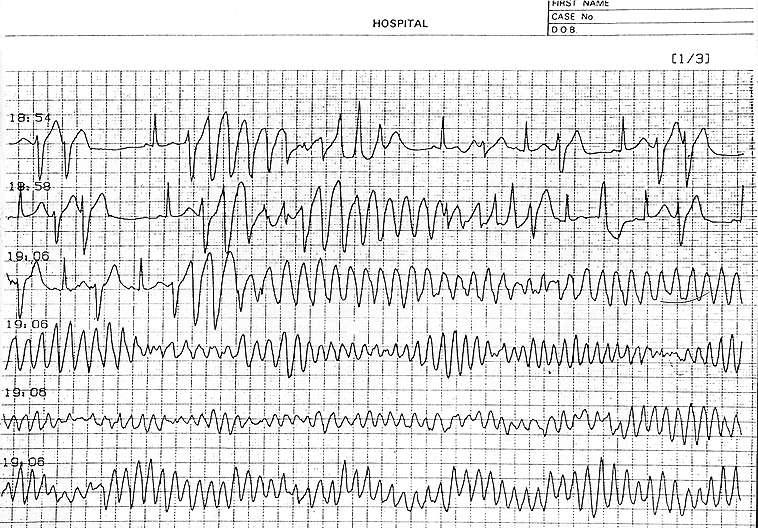 Holter ECG Recording in LQTS Patient with Syncope (representative strips of