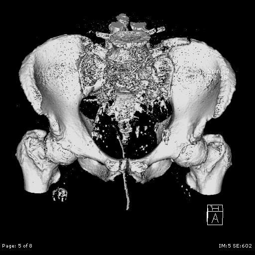 al s findings suggest that CT scans may assist with an overall rating of pelvic ring stability and classification of specific features of pelvic ring disruption.