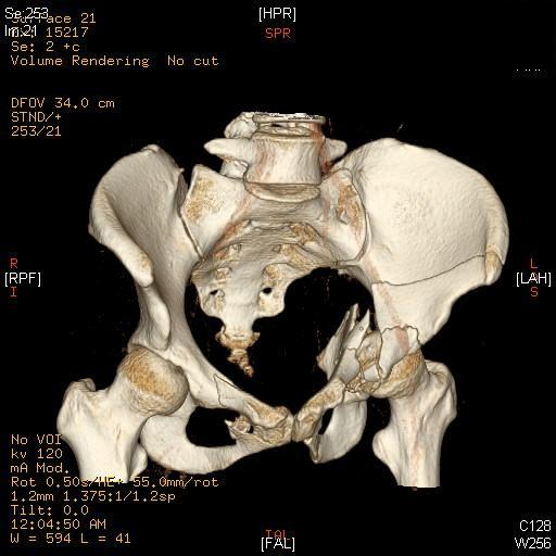 Figure 4: Example of better quality 3D CT reconstruction The group of patients in our study represent the most severe pelvic ring fractures, who demonstrate a high risk of mortality and long term