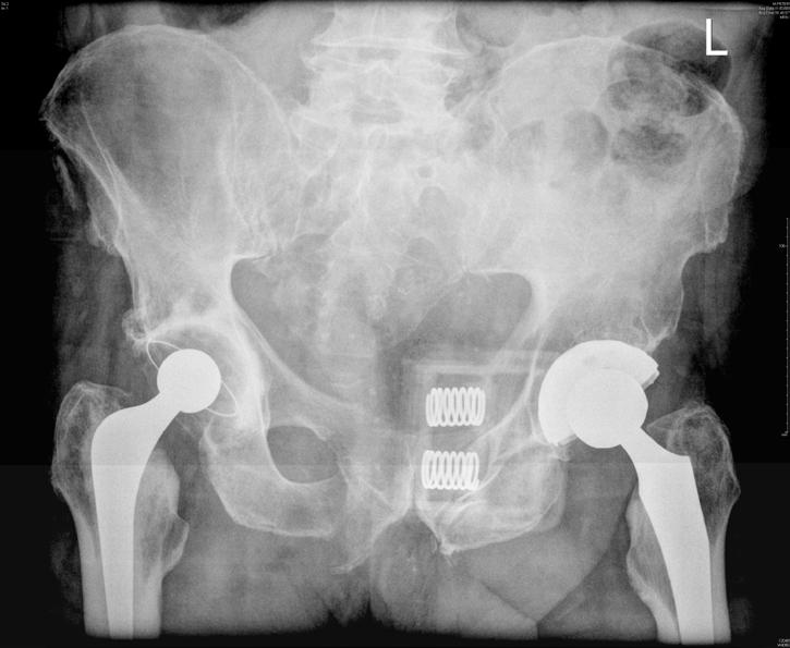 Figure 5: Plain radiograph of patient with binder in situ Similarly, the decision to intervene (e.g. emergency placement of an external fixateur) can be made prior to routine CT scanning in the ED