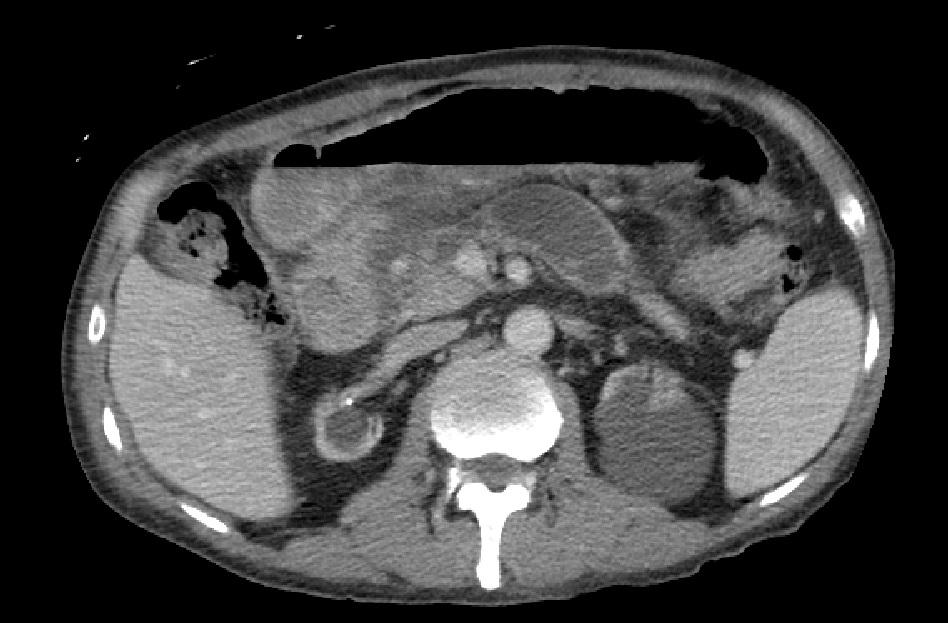 10 OUR PATIENT: CT IMAGING OF PANCREATIC FLUID COLLECTION CT Abdomen and Pelvis with contrast: Lym/Gen A/P A/P Multiple fluid collections in the pancreatic bed and uncinate process.