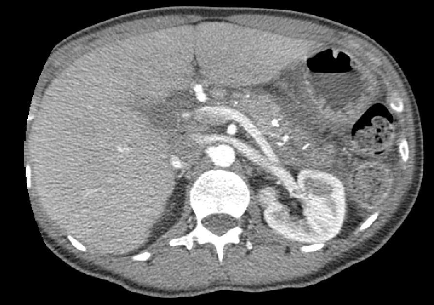 CT Multiphase pancreas: Chronic pancreatitis Extensive calcifications in the