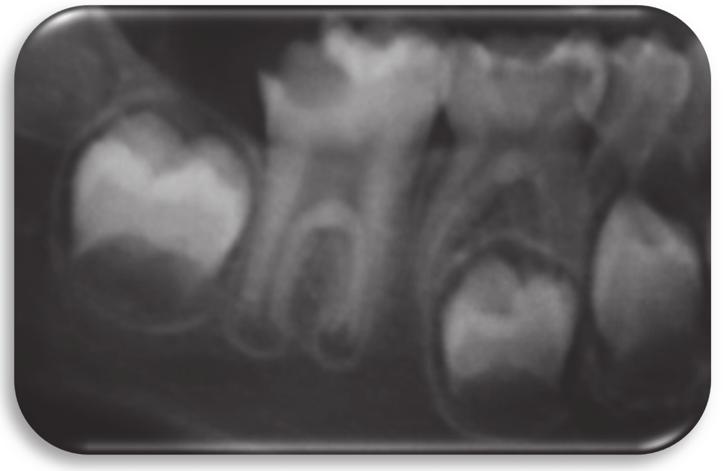 2 Case Reports in Dentistry (e) (f) Figure 1: Initial radiograph of large occlusodistal caries on tooth 36, extending to the pulp chamber and with periapical translucencies.