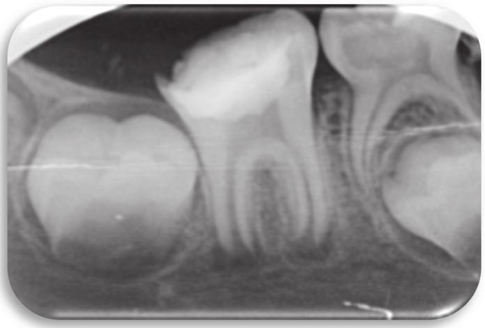 Periapical radiograph of MTA over the blood clot and the pulp chamber sealed with glass ionomer, composite, and metal crown.