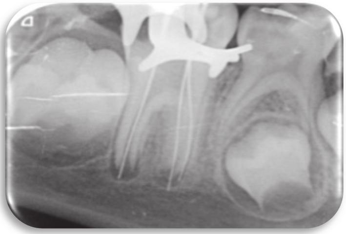 By comparing this radiograph with those taken previously, the periapical radiotranslucency has decreased and there is further closure of the apical foramen.