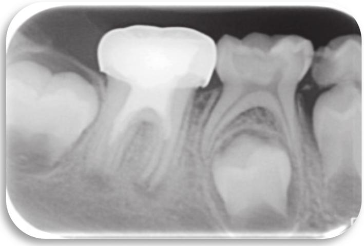 The periapical radiotranslucency has practically disappeared; there is further thickening of the dentinal walls and the apical foramen has almost closed. there was a large cavity.
