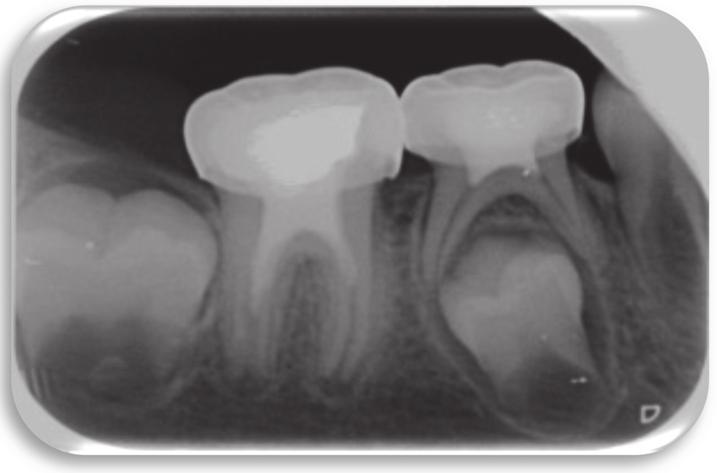 Radiographically, a mesioocclusodistal caries was observed on tooth 46, extending into the pulp chamber. The image showed periapical radiotranslucency and open apices.