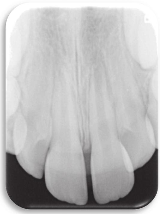 Case Reports in Dentistry 3 (e) (f) Figure 2: Periapical radiograph image, 6 months after a trauma-induced subluxation of tooth 21, shows open apex of more than 2 mm, with periapical