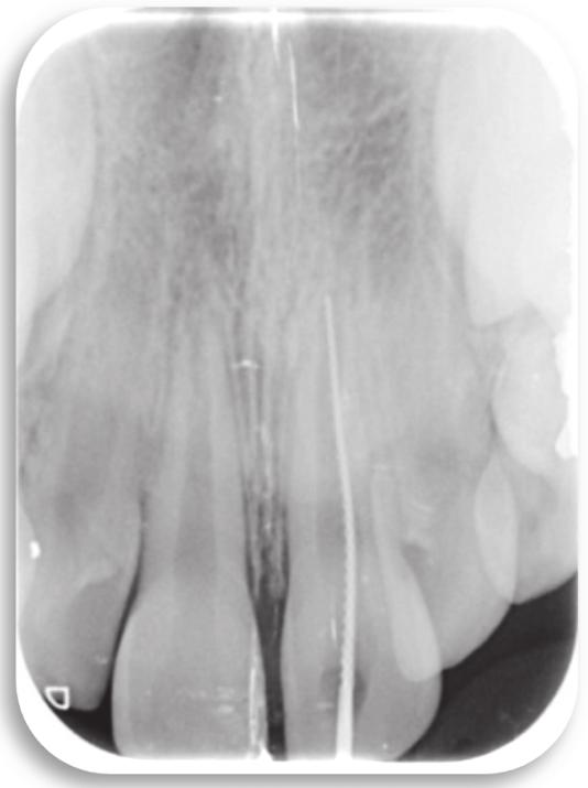 Follow-up radiograph at 3 months, the periapical radiotranslucency at tooth 21 has disappeared.