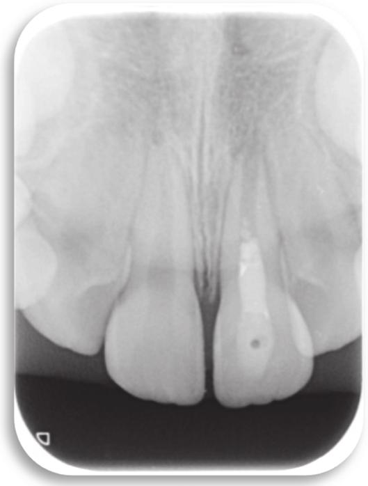 months, the periapical pathology has noticeably improved, then healed, and increased dentinal wall thickness and an almost closed apical foramen can be observed (Figure 1). 2.2. Case 2.