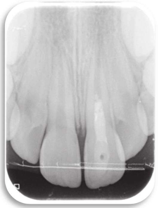 At the clinical examination, change of color was observed in the crown of 21 and a periapical abscess had appeared.