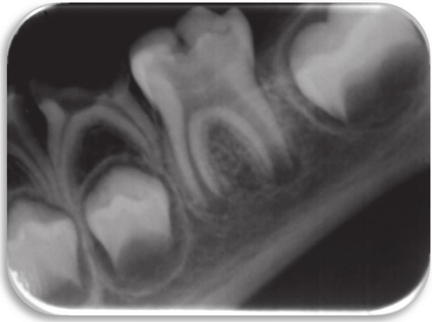 4 Case Reports in Dentistry Figure 3: Initial periapical radiograph: occlusal caries can be observed extending into the pulp chamber and radiotranslucency on the root apices.